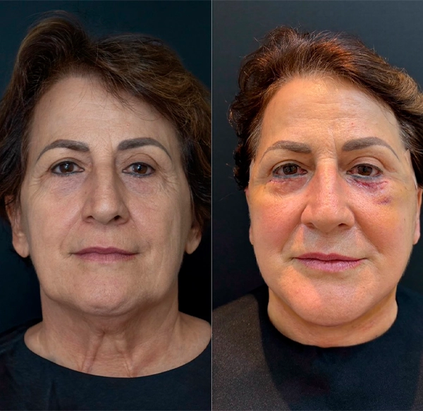 ANTES E DEPOIS 1 - DRA LETHICIA