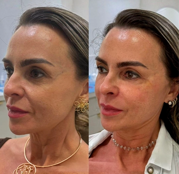 ANTES E DEPOIS 2 - DRA LETHICIA
