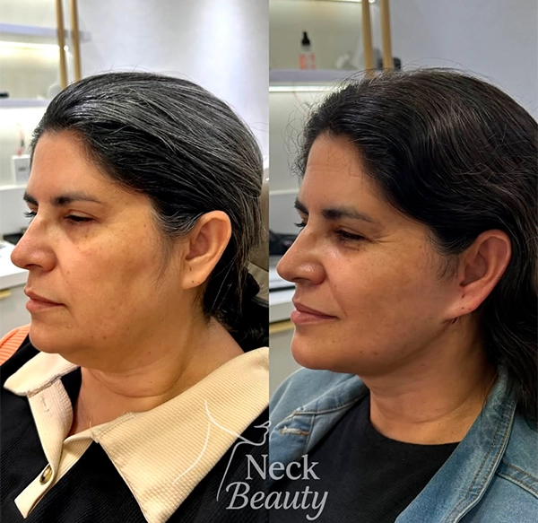 ANTES E DEPOIS 3 - DRA LETHICIA