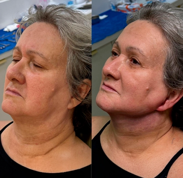 ANTES E DEPOIS 4 - DRA LETHICIA