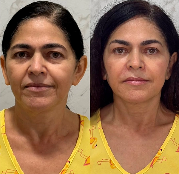 ANTES E DEPOIS 5 - DRA LETHICIA