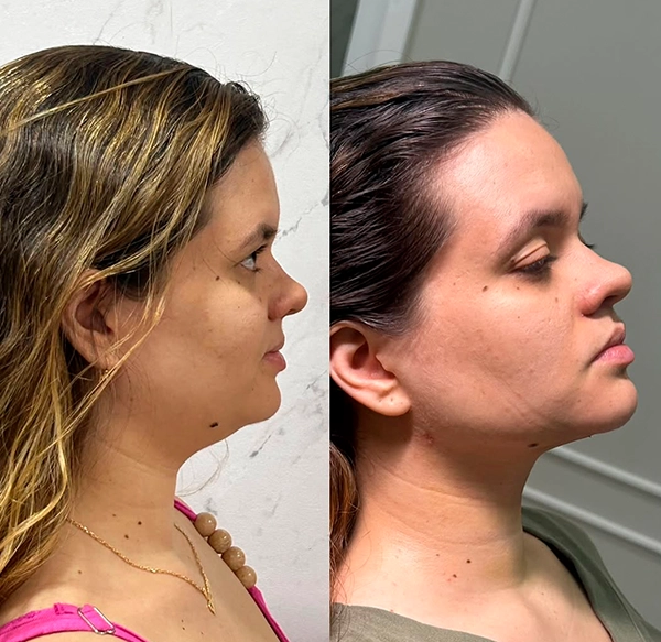 ANTES E DEPOIS 6 - DRA LETHICIA