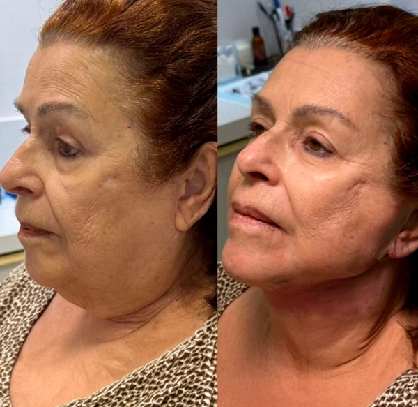 ANTES E DEPOIS 7 - DRA LETHICIA