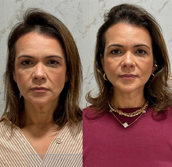 ANTES E DEPOIS 8 - DRA LETHICIA