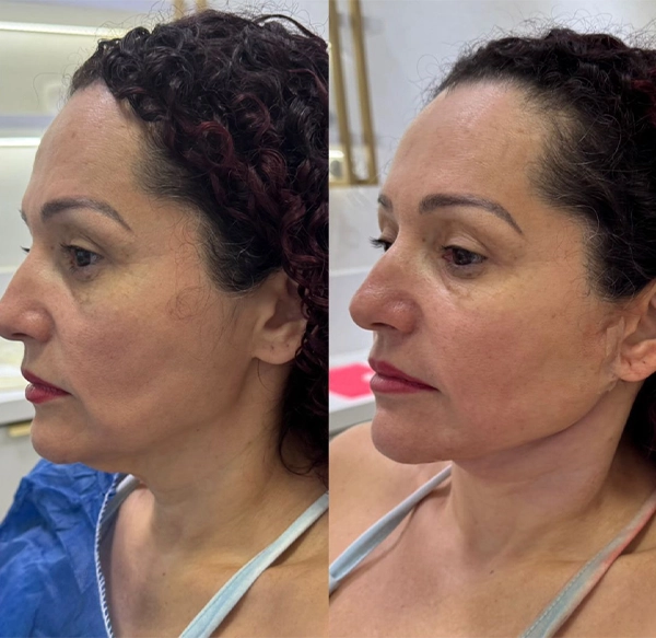 ANTES E DEPOIS 9